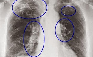 Ojo en la Comarca del Almanzora: La exposición a sílice cristalina respirable puede producir EPOC, tuberculosis o enfermedad renal, según una experta