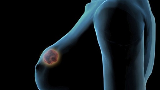 De los 30.000 diagnósticos anuales de cáncer de mama que ocurren en España, entre un 5-10% son hereditarios