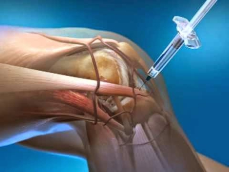  En pruebas un medicamento inyectable que regenera el cartílago de la rodilla en personas con osteoartritis 